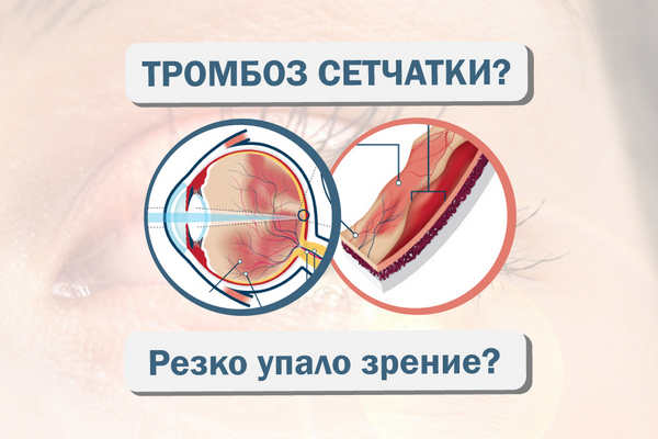 тромбоз сетчатки